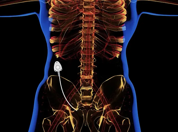 Surgical Implantable Picc Port Vascular Access Device Port-a-Cath 5