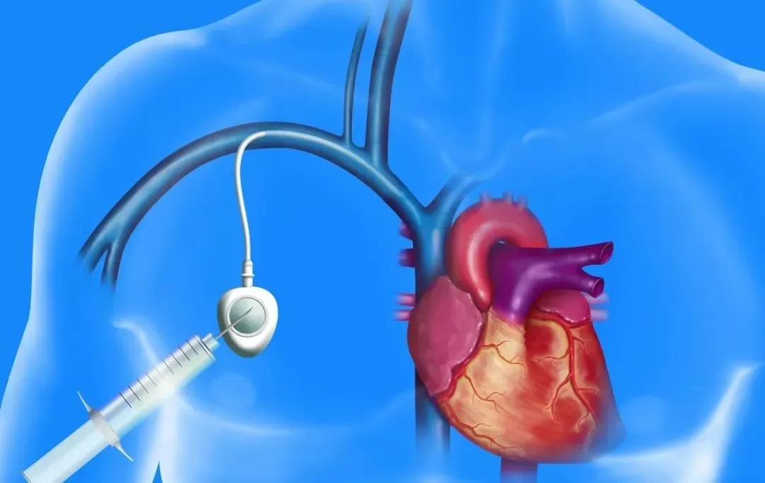 Surgical Implantable Picc Port Vascular Access Device Port-a-Cath 4