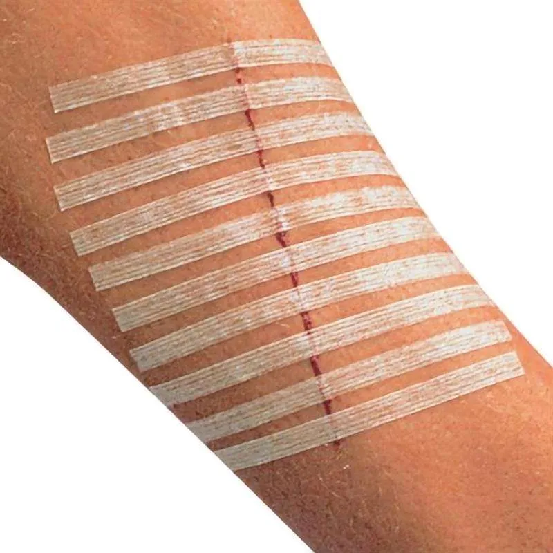 Hypoallergenic Medical-Grade Sterilized Skin Closure Strips for Gentle Laceration Repair & Post-Surgical Wound Care 5