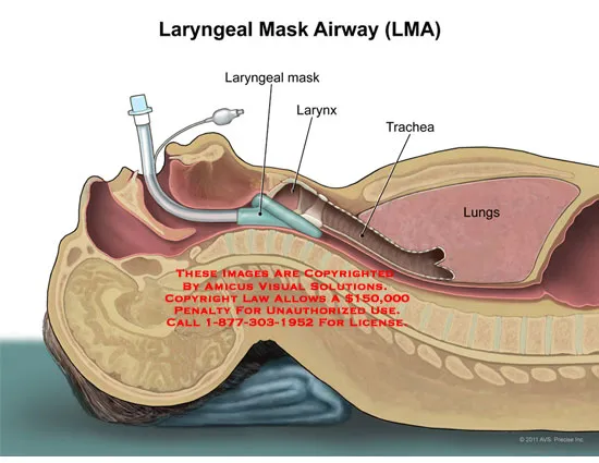 laryngeal mask